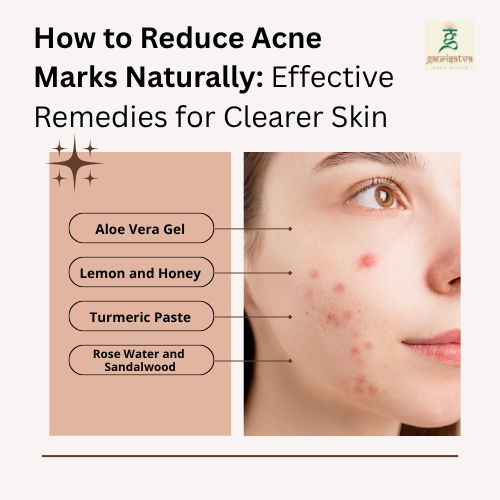 How to Reduce Acne Marks Naturally